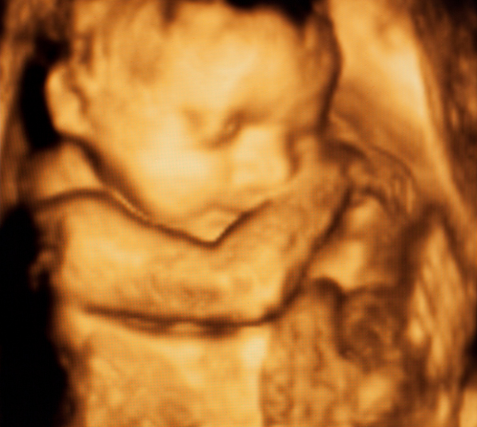 3D/3D doppler ultasound of fetus. Fetus seen in 3D-Fetal medicine at Petals health