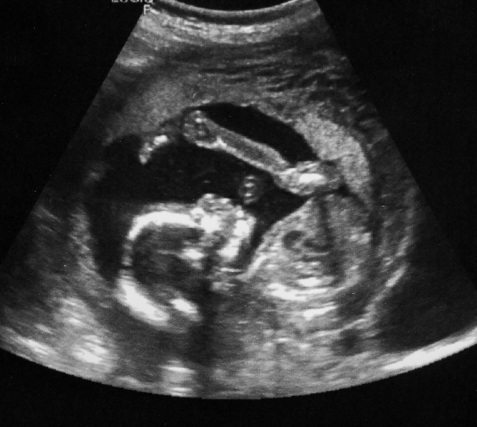 Second trimester scans