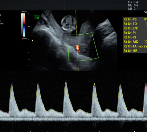 Pre-Eclampsia Screening via ultrasound - checking the blood flow to the uterus.