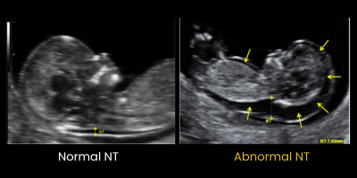 Normal NT Scan Vs Abnormal NT measurement