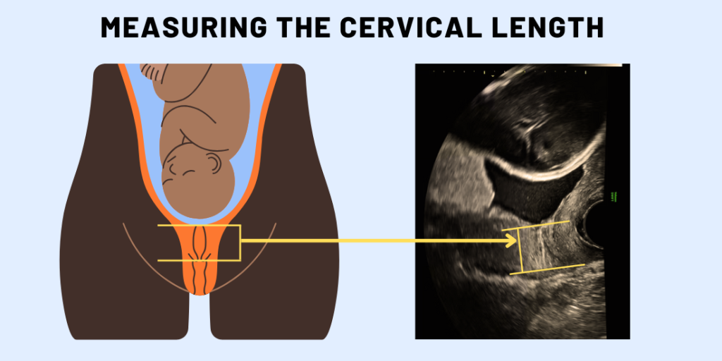 A cervical length scan assesses the risk of preterm birth, ensuring proper monitoring and care for a healthy pregnancy journey. A short cervical measurement early in pregnancy can indicate cerical insuffeciency with hrightened risk of preterm birth