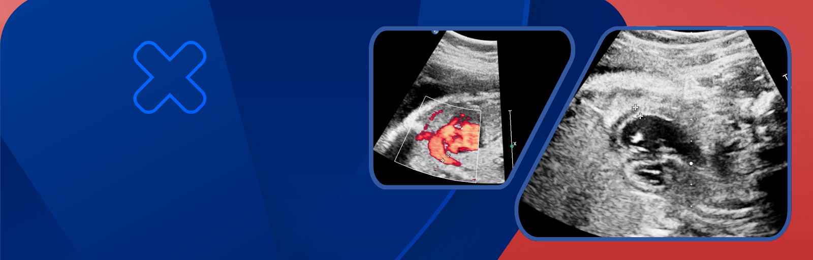 Understanding Fetal Echocadiography - A specialised scan for analysing Fetal Heart and early detection of congenital Heart defects.