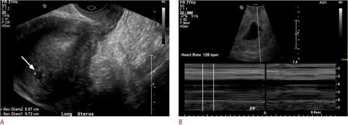 Image A. Initial transvaginal ultrasonography (TVUS) shows a vague hypoechoic collection measuring 7 mm in the uterine fundus (arrow). The morphology was not typical for an intrauterine pregnancy. Image B. Subsequent TVUS 2 weeks later demonstrates an intrauterine gestational sac with an embryo with heart rate of 126 bpm.